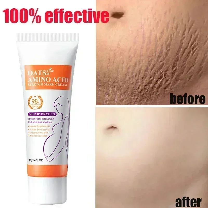 Maternity Stretch Mark Permanent Removal cream Brighten Anti-Winkle