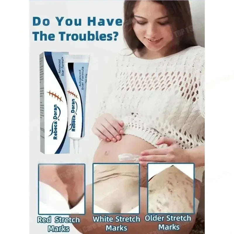 Removing Old Red and White Line Oil Stretch Mark Repair for Pregnant Women Anti-wrinkle Care
