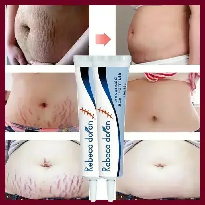 Removing Old Red and White Line Oil Stretch Mark Repair for Pregnant Women Anti-wrinkle Care