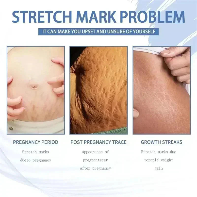 Maternity Stretch Mark Permanent Removal cream Brighten Anti-Winkle