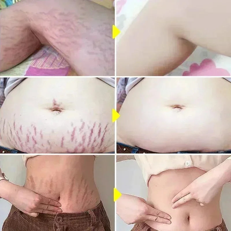 Maternity Stretch Mark Permanent Removal cream Brighten Anti-Winkle