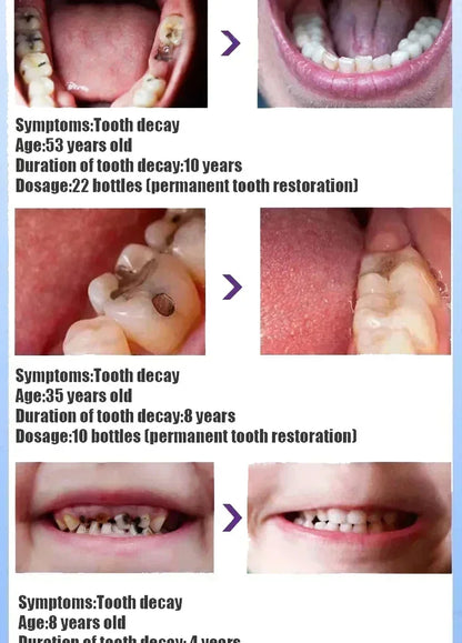 Toothpaste of Teeth Whitening Repair of Cavities Caries Removal of Plaque Stains Decay