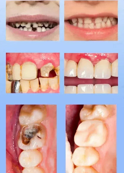 Toothpaste of Teeth Whitening Repair of Cavities Caries Removal of Plaque Stains Decay