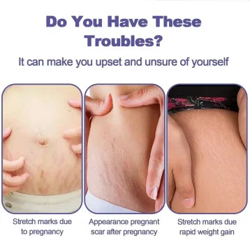 Remove Pregnancy Stretch Marks Cream Improves Elasticity Fade Growth Lines