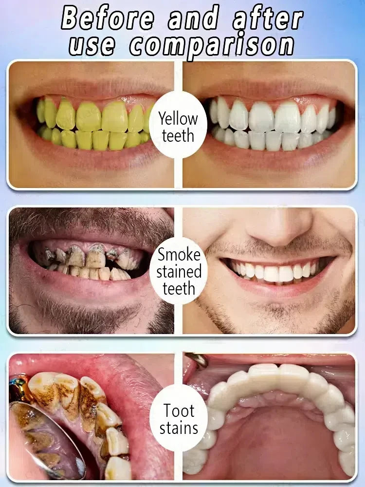 Toothpaste of Teeth Whitening Repair of Cavities Caries Removal of Plaque Stains Decay