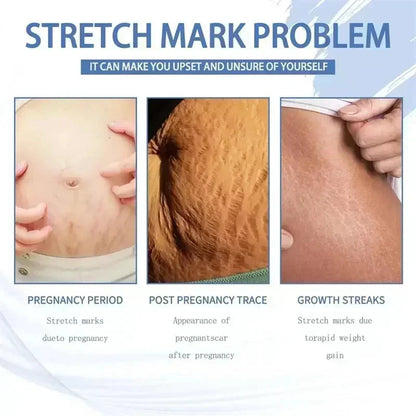 Maternity Stretch Mark Permanent Removal cream Brighten Anti-Winkle
