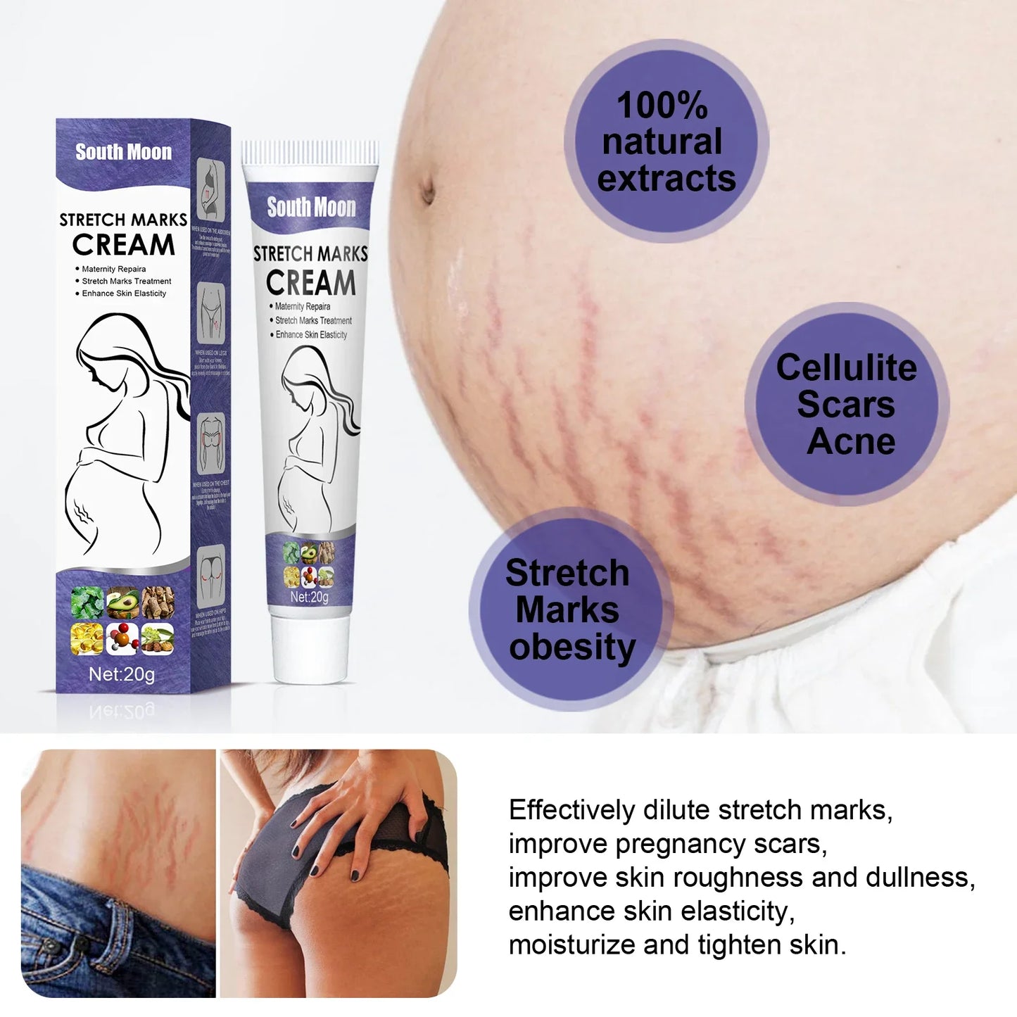 Remove Pregnancy Stretch Marks Cream Improves Elasticity Fade Growth Lines