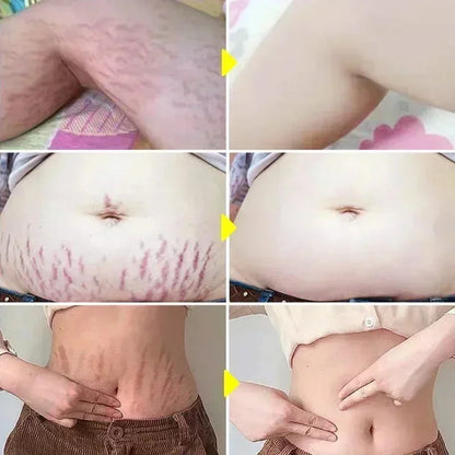 Maternity Stretch Mark Permanent Removal cream Brighten Anti-Winkle